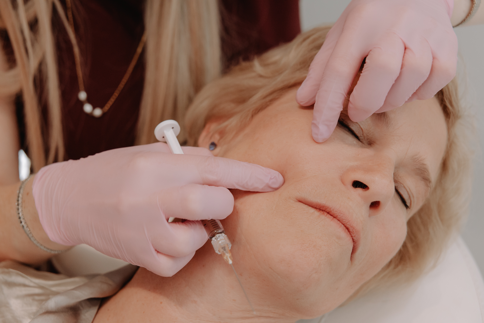 Behandeling volumeverlies wangen met filler bij Skinject Clinic in Waasmunster
