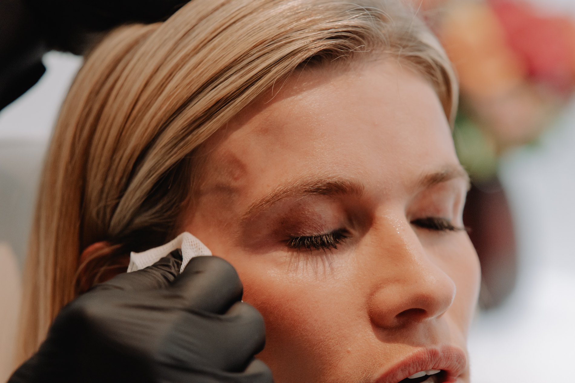 Meer dan esthetiek: hoe botulinetoxine helpt bij migraine en spanningshoofdpijn