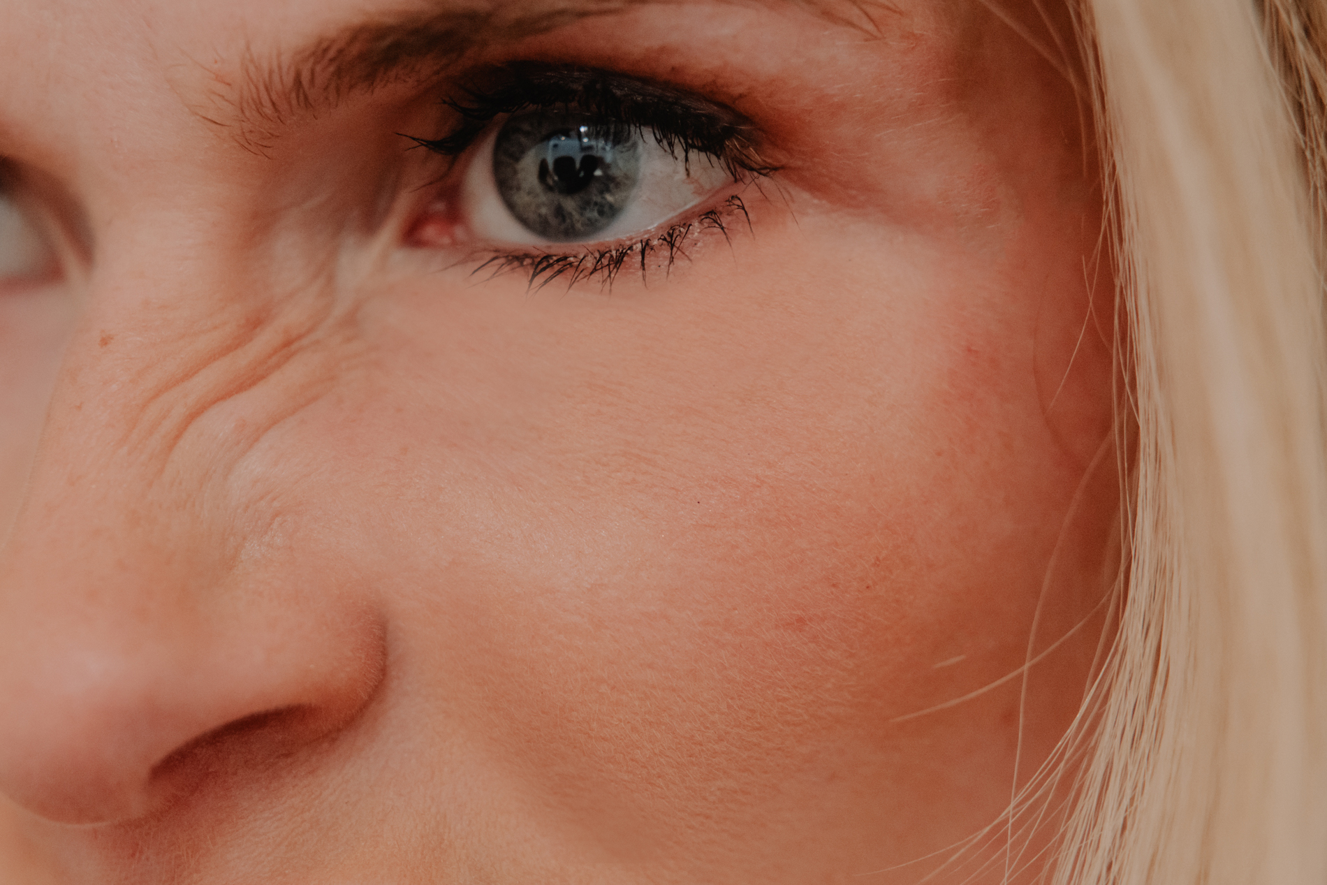 Behandeling neusrimpels bij Skinject Clinic in Waasmunster