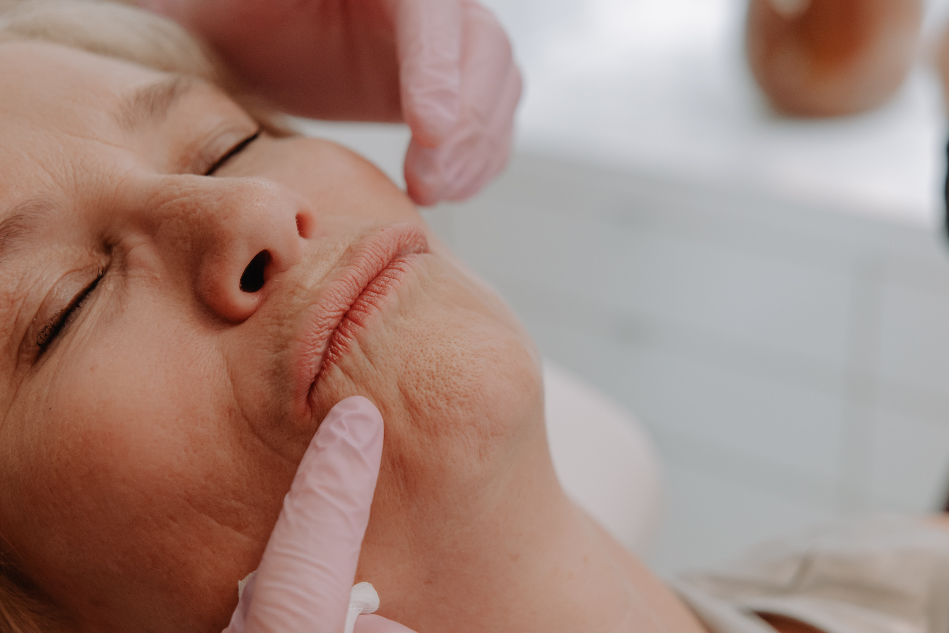 Lijntjes rond de mond (rokerslijntjes)